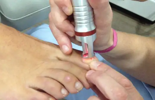 eliminación de hongos en las uñas